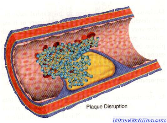 ĐAU THẮT NGỰC KHÔNG ỔN ĐỊNH