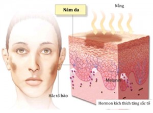 Chia sẻ cách trị nám da mặt sau khi sinh nở